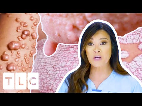 Dr. Lee's MOST Interesting Cases: Mysterious Rashes, Cysts & More! | Dr Pimple Popper