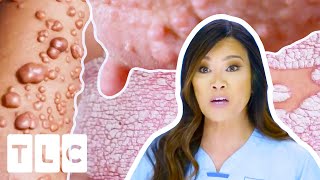 Dr. Lee's MOST Interesting Cases: Mysterious Rashes, Cysts \& More! | Dr Pimple Popper
