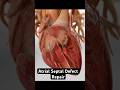 Repairing a hole in your heart (3D Animation)
