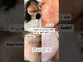 اطعمة تزيد من ظهور حب الشباب اكسبلور ترند 