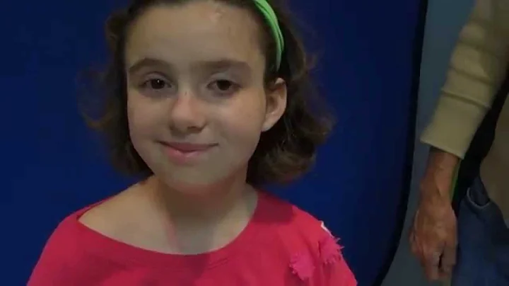 Temporalis Myoplasty for Smile Reanimation After Facial Paralysis