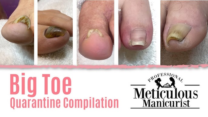 Here's how to prevent injury to lifted thick toenails: ( link in  bio)  #meticulousmanic