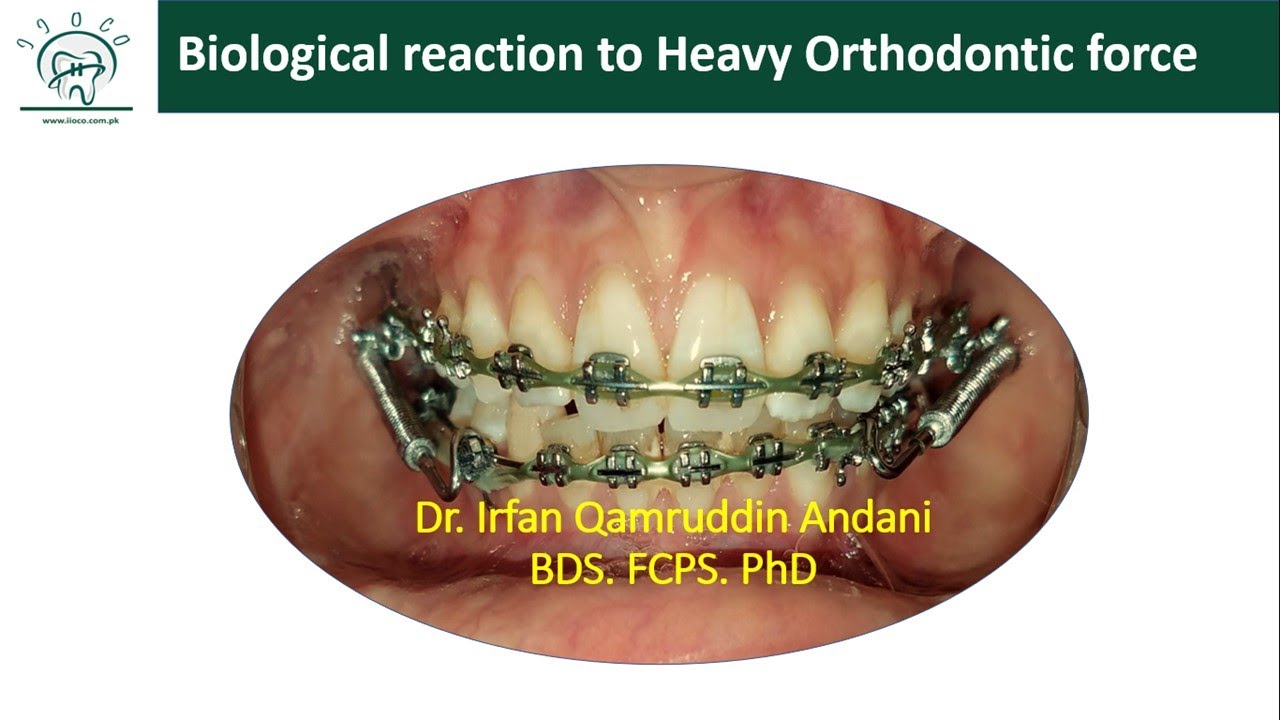 Biological Response of PDL to Heavy Orthodontic force YouTube