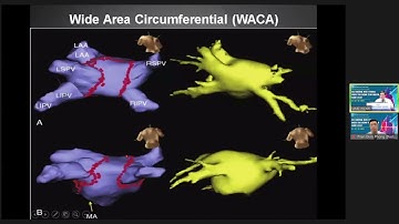 Thăm dò và cắt dốt rung nhĩ 2021