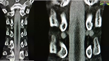 Cerebrospinal Fluid CSF Leaks in Marfan and Related Conditions