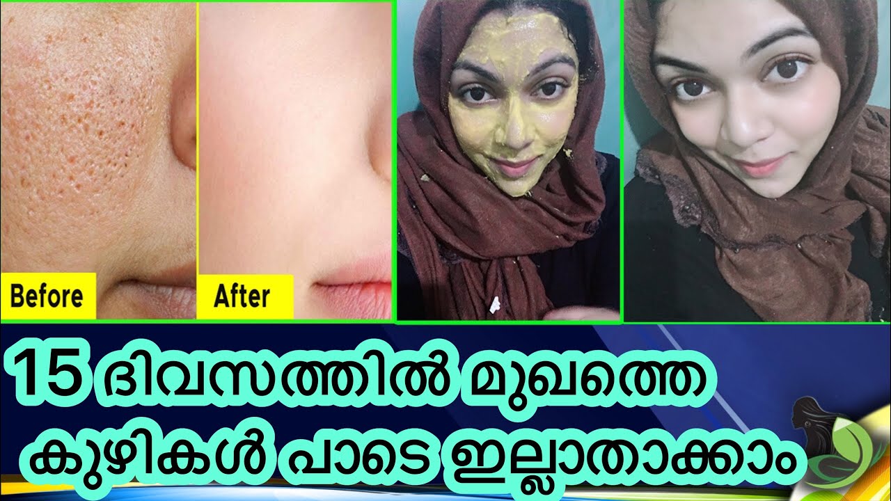 How To Get Ride Of Open Pores At Home With Peermanently Malayalam how-to-get-ride-of-open-pores-at-home-with-peermanently-malayalam