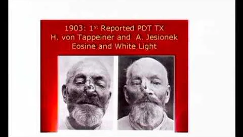PDT in Oncology - Dr. Ron Allison