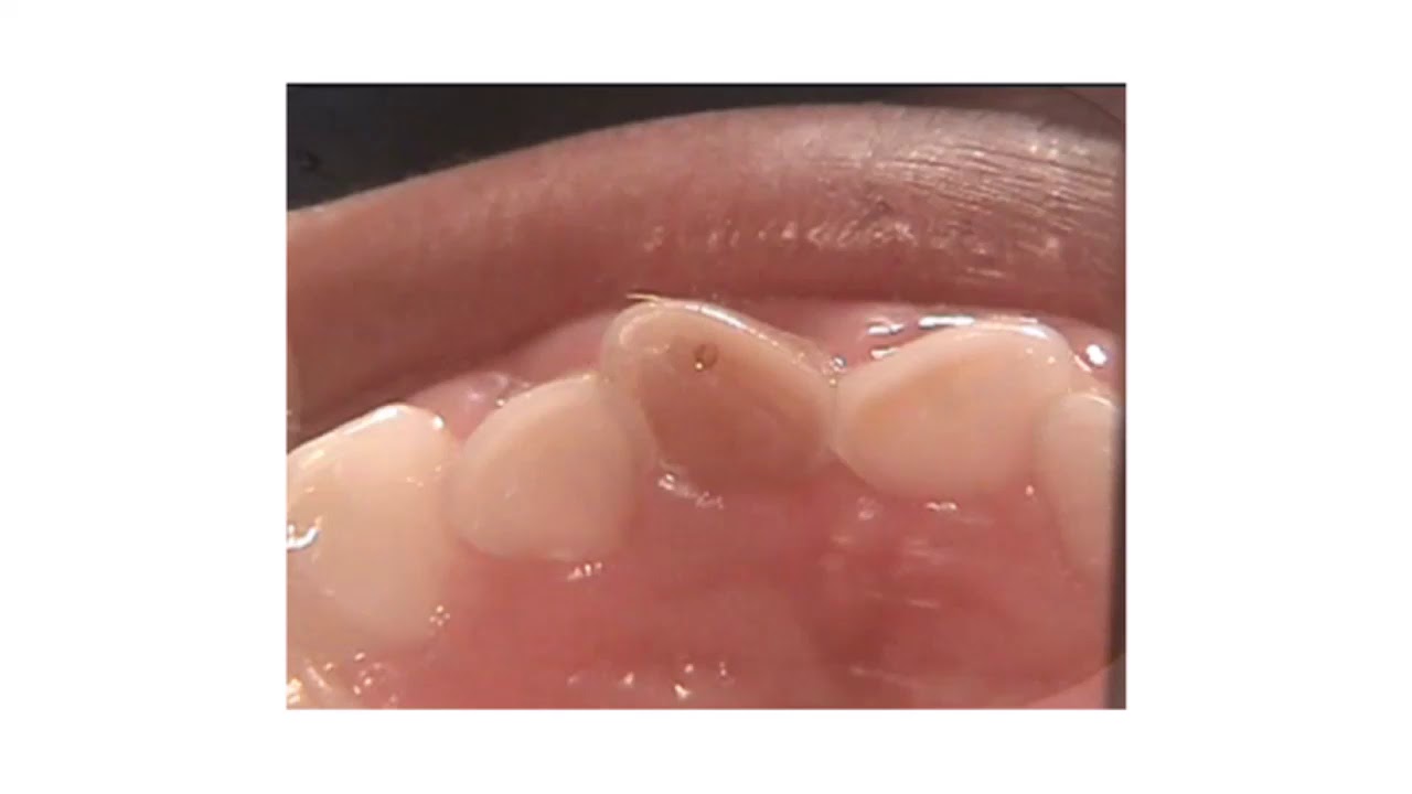 pulpectomia 10 03 20 YouTube