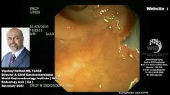 CBD stricture in setting of chronic pancreatitis