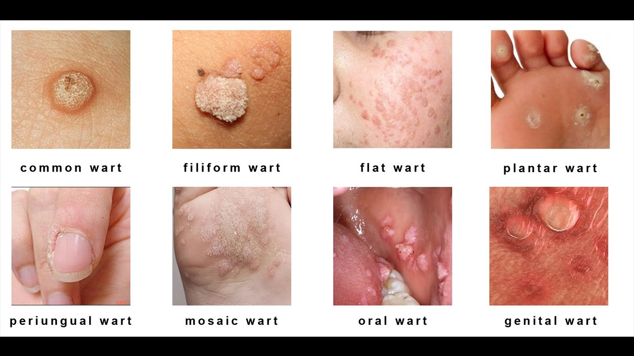 removal hpv genital warts