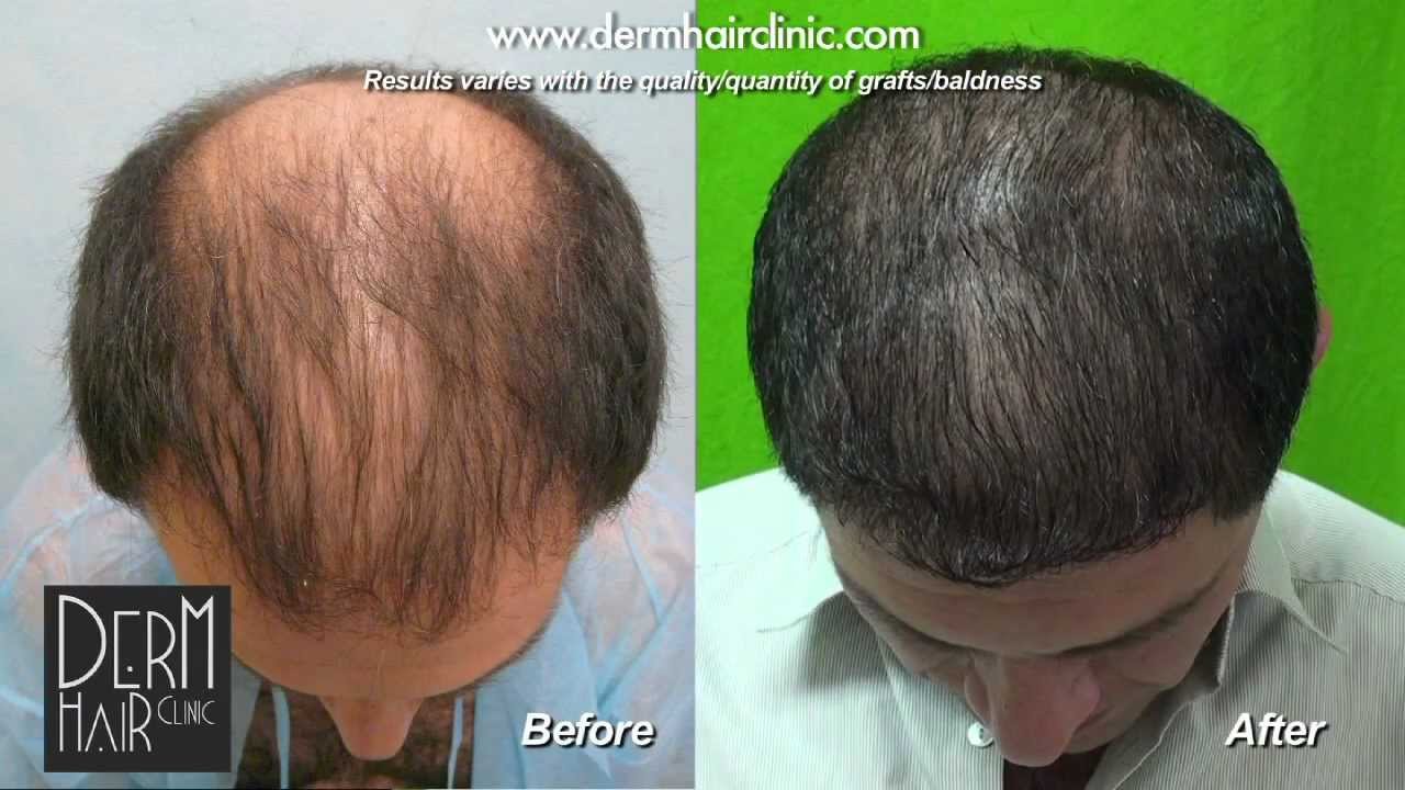 FUE Hair Transplant 5805 Grafts on IRRADIATED SCALP by Dr Juan Couto at  FUExpert Clinic  YouTube