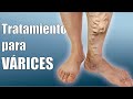 Las VÁRICES y sus TRATAMIENTOS 🦵 CAUSAS y SÍNTOMAS de las VÁRICES 💪 FLEBOCENTER 👣 Dr IVÁN GUTIÉRREZ