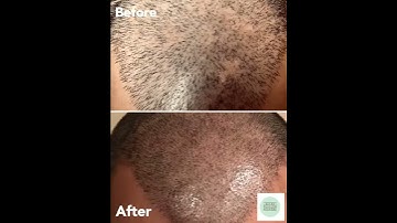Scalp Micropigmentation - Training Course