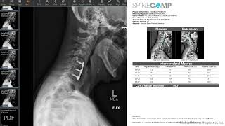 Strain Based Fusion Assessment Demonstration Video