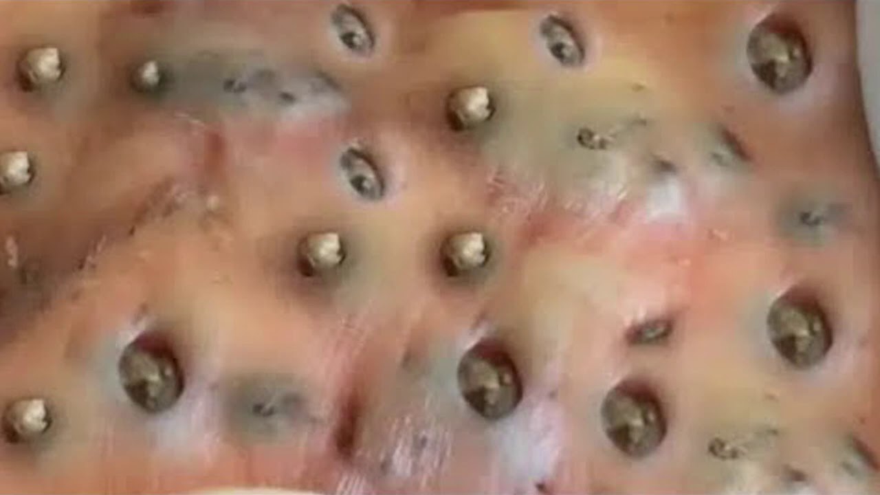 Dr Pimple Popper Blackhead Removal