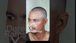 MANScalp X Derek Ramsay. Scalp Micropigmentation Philippines