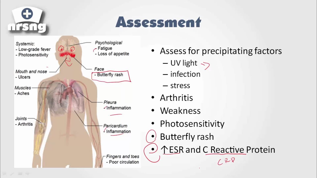 Lupus erythematosus fájó ízületek. Mi állhat az ízületi merevség hátterében?