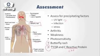 Lupus (SLE) NCLEX® Review | NRSNGacademy.com