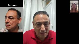 Fort Lauderdale Hair Transplant Clinic | Permanent Hair Restoration