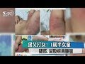 狠父打女 1歲半女童 腿部 屁股瘀青腫脹 狠父打女 1歲半女童 腿部 屁股瘀青腫脹
