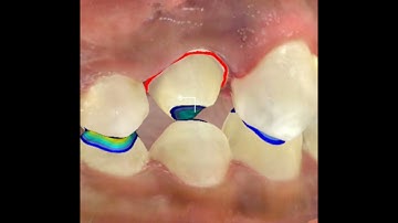 Zirconia Crown - iTero Element 5D Plus Intra Oral Scanner, Digital Dentistry.
