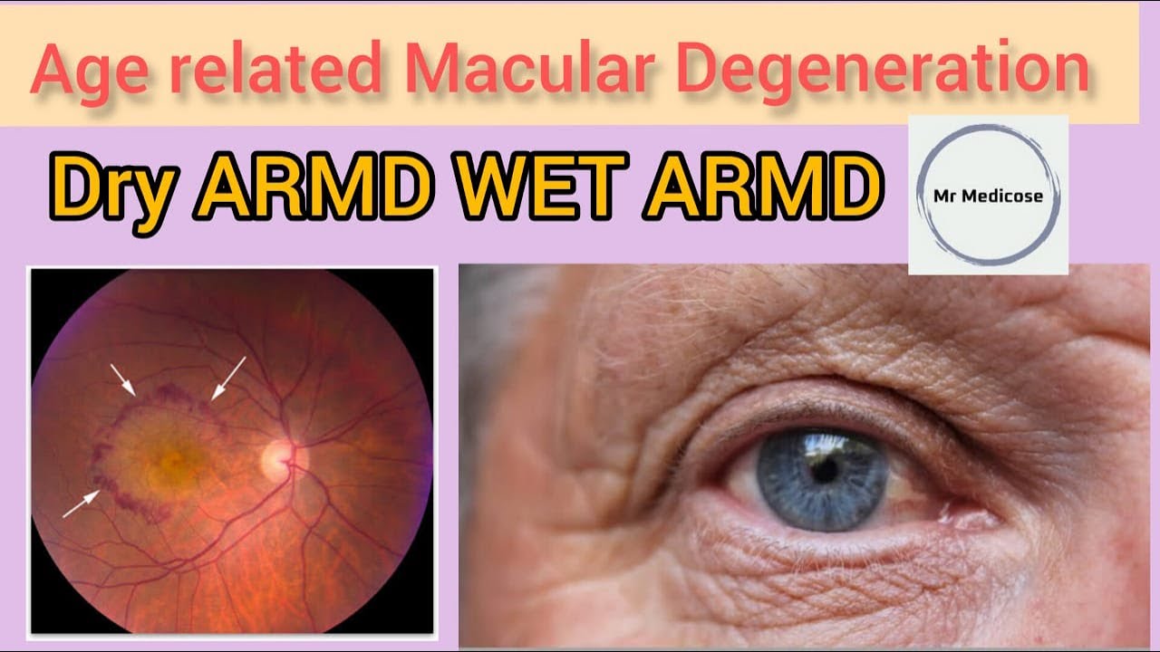 Age Related Macular Degeneration(ARMD) | Dry/Atrophic ARMD | Wet/Exudative ARMD|Signs|Treatment