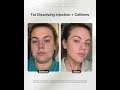 Struggling with stubborn facial fat? See the contouring results of Cellinew and Fat Dissolving duo✨
