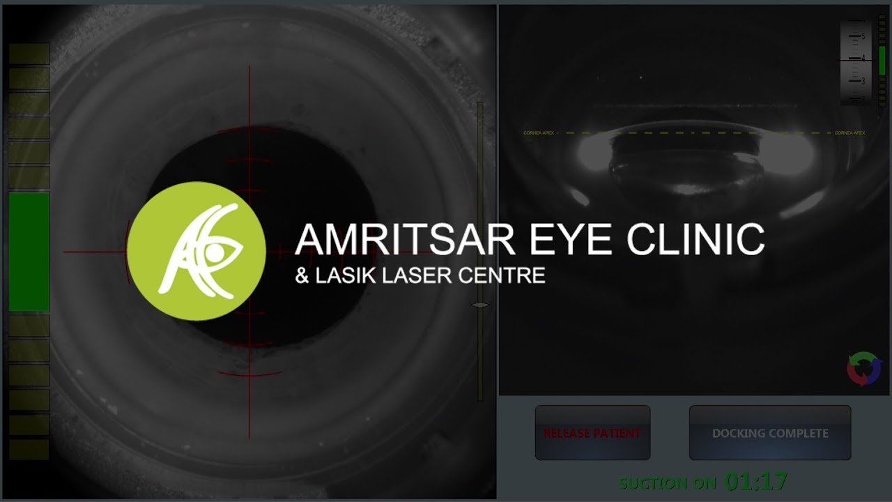 Femtosecond Laser for Cataract Surgery YouTube