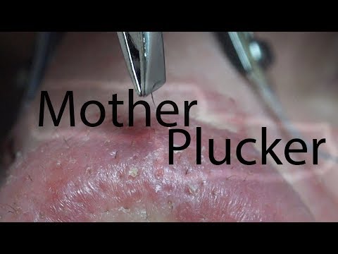 Mother Plucker | Life With Cystic Acne Documentary #