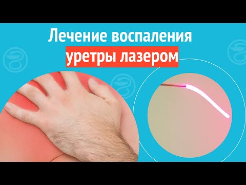 ✅ Лечение воспаления уретры лазером. Клинический случай №1225