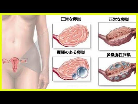 女性が知っておくべき卵巣嚢腫のこと