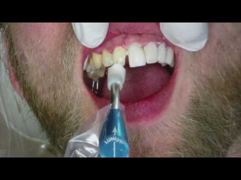 Veneers Dental Procedure at Cosmetic Dental Associates in San Antonio, TX