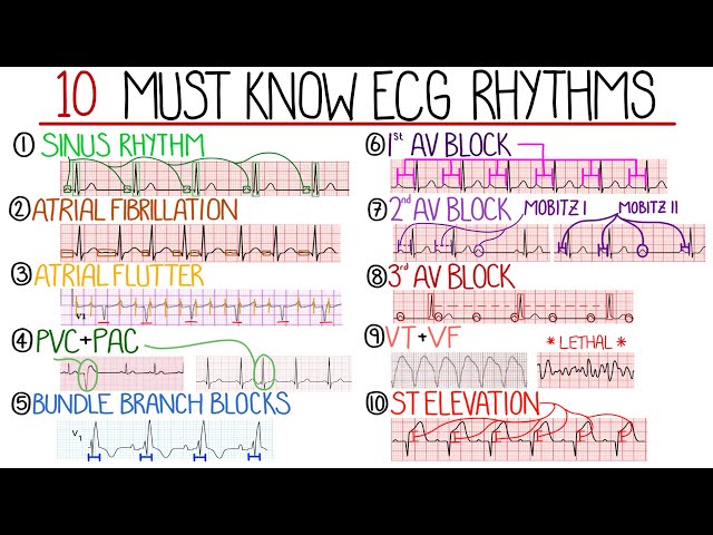 Most Common ECG Patterns You Should Know class=