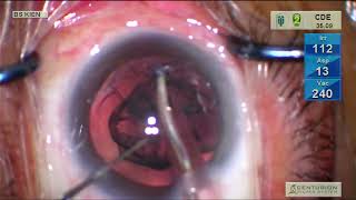 A beautiful case: Posterior Capsular Fibrosis with Dendritic Pattern