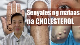 Mga senyales na mataas ang cholesterol