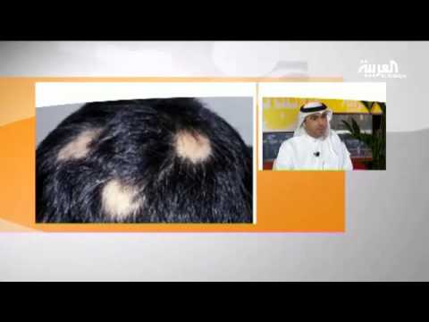 الثعلبة هو مرض غير خطير وغير معدي