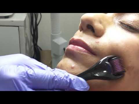 DERMA ROLLER-TREATMENT FOR ACNE  SCARS