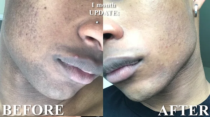 How to Fade a Beard shadow in 1 month | Get rid of hyperpigmentation - DayDayNews