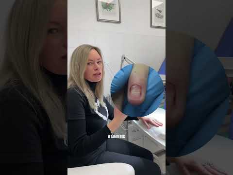 Лечение грибка после маникюра #shorts #лечениеногтей #грибокногтей #грибок #ногти #микоз #подология