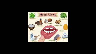 Home remedies for Mouth ulcer