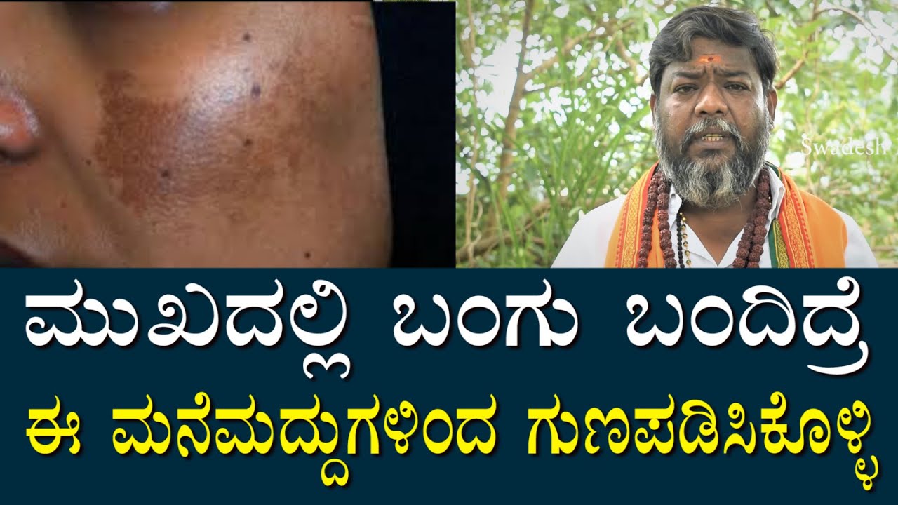 ಬಂಗು ಬಂದಿದ್ರೆ ಈ ಮೂಲಿಕೆಗಳಿಂದ ಗುಣಪಡಿಸಿಕೊಳ್ಳಿ | (bangu) Remedy For face white paches