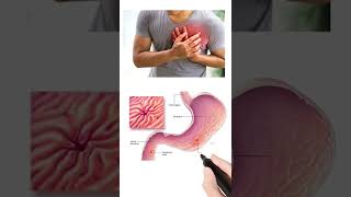 Omee Capsule Uses And Sideeffects Best Tablet For Acidity Reflux