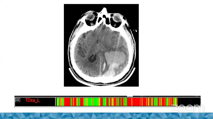 Multimodal Monitoring in Neurocritical Care