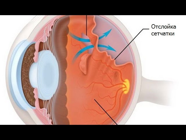 Отслойка сетчатки глаза - причины, симптомы (признаки) и лечение