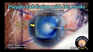 CataractCoach 1583: pseudo-exfoliation with iris hooks