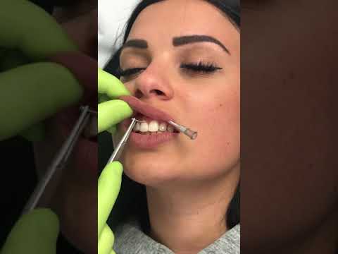 Video: Smiley Piercing: Bilder, Fordeler, Ulemper, Prosedyre, Omsorg, Risiko, Mer