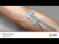 BD WavelinQ Cannulation Motion Graphic