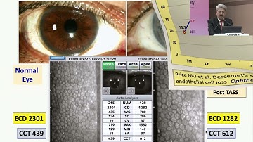 AIOC2022 GP92 topic Dr  SAMAR KUMAR BASAK The Journey of DSEK To DMEK  Experience of a Large Volume