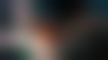 symphysis bone graft augmantation by dr nishit shah 2017