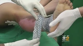 Doctors Treating Major Burns Using Fish Skin